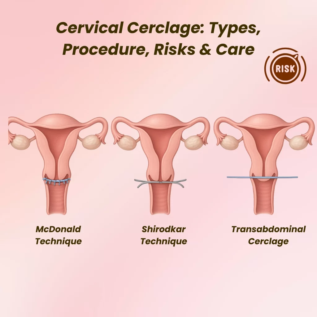 Cervical Cerclage