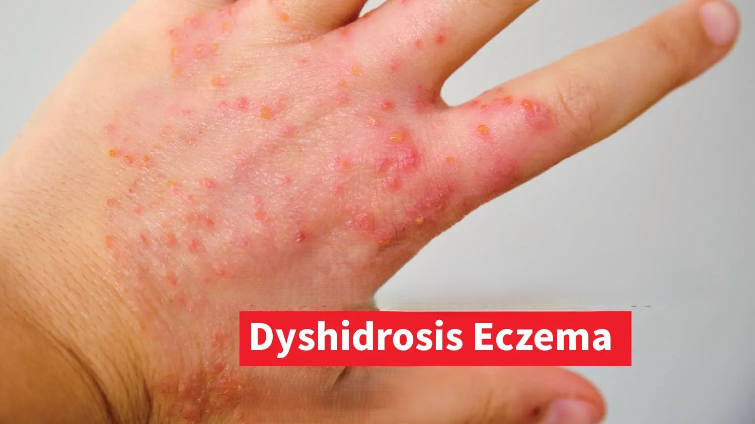 Dyshidrosis
