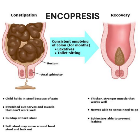 Encopresis