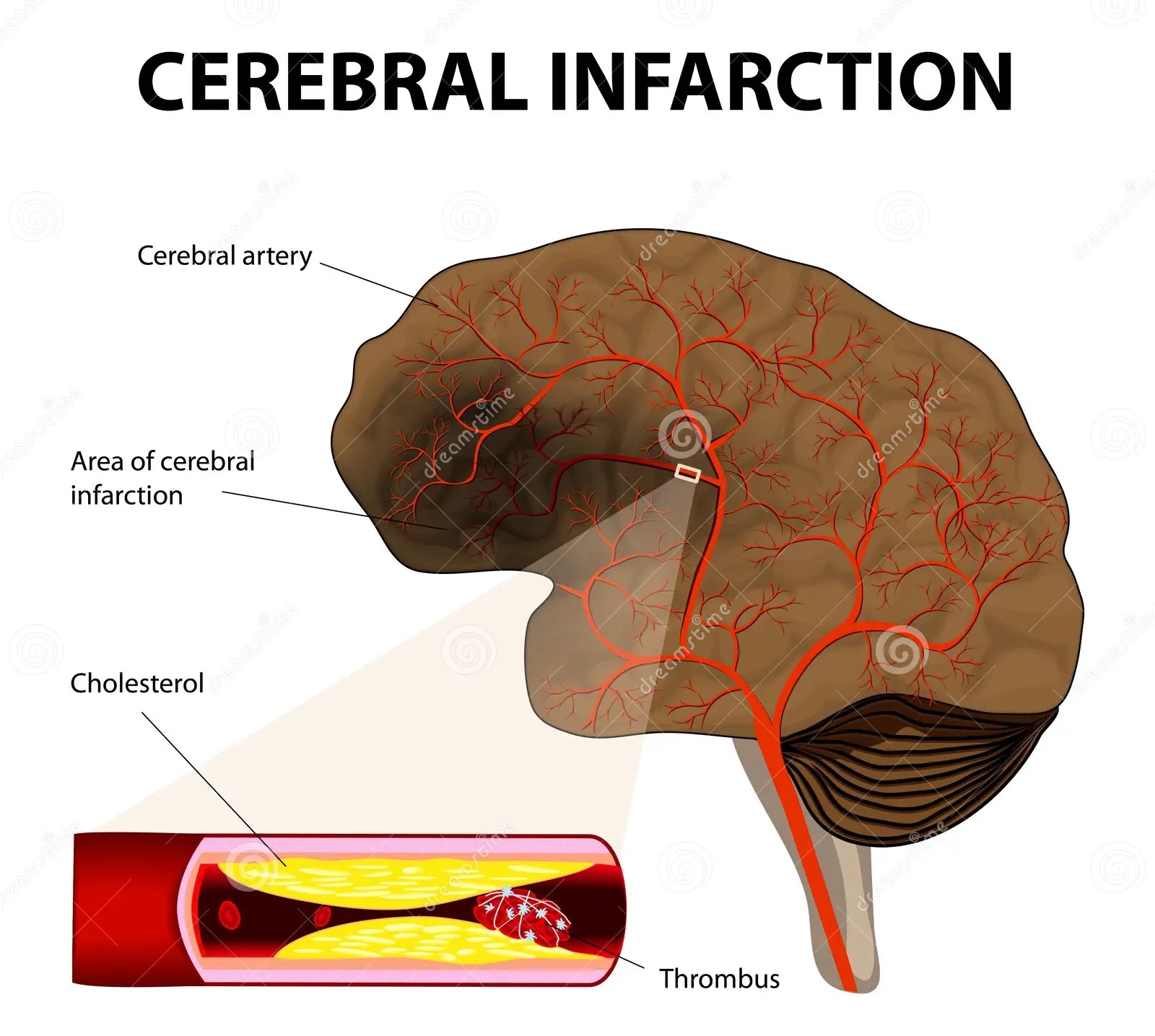 Cerebral Infarction