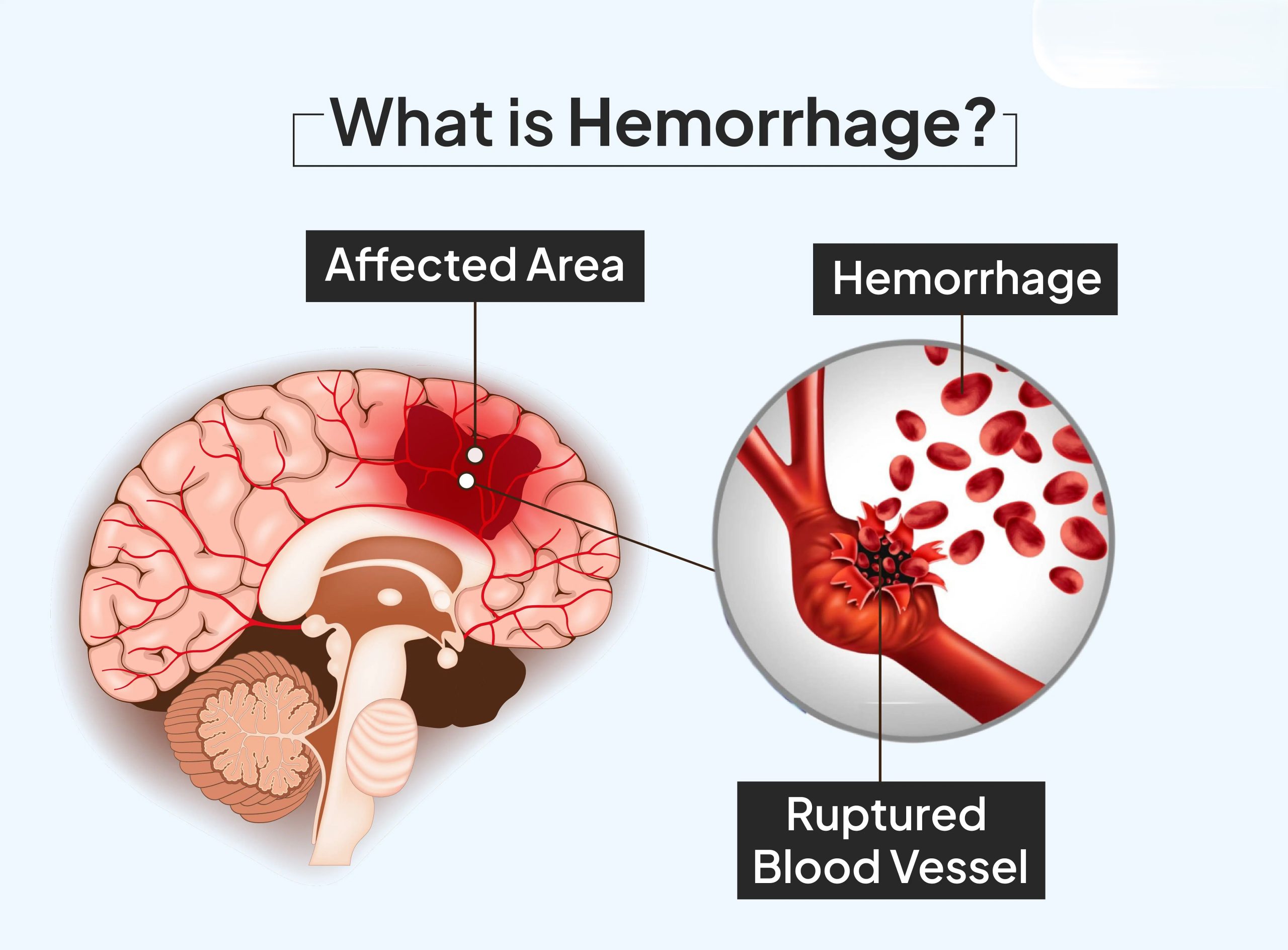 Hemorrhage